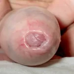 الشبم (ضيق القلفة): الأسباب والعلاج