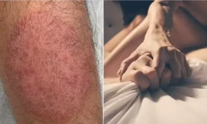 جفاف جلد القضيب : الأسباب وهل يستدعي الأمر القلق؟