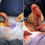 متى يجب على الرجال طلب المساعدة لعلاج مرض بيروني؟