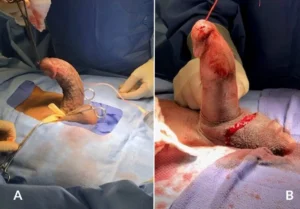 متى يجب على الرجال طلب المساعدة لعلاج مرض بيروني؟